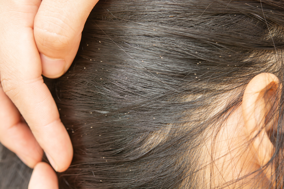 Lice in hair and comb on white background